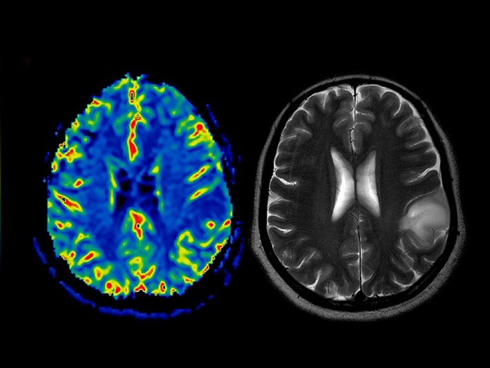 neurobiological roots of perfectionism