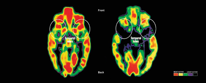 scan of a brain